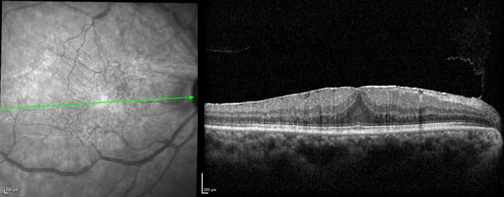 OCT image of epiretinal membrane (macular pucker)