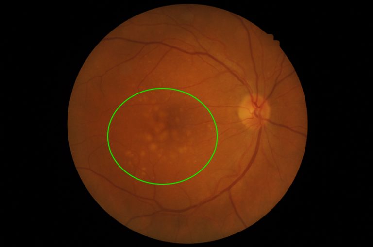 Stages of agerelated macular degeneration Macular Disease Foundation
