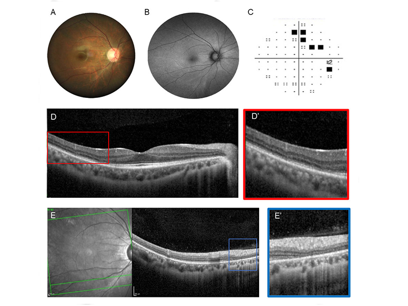 Hidden In Plain Sight Macular Disease Foundation Australia Macular 